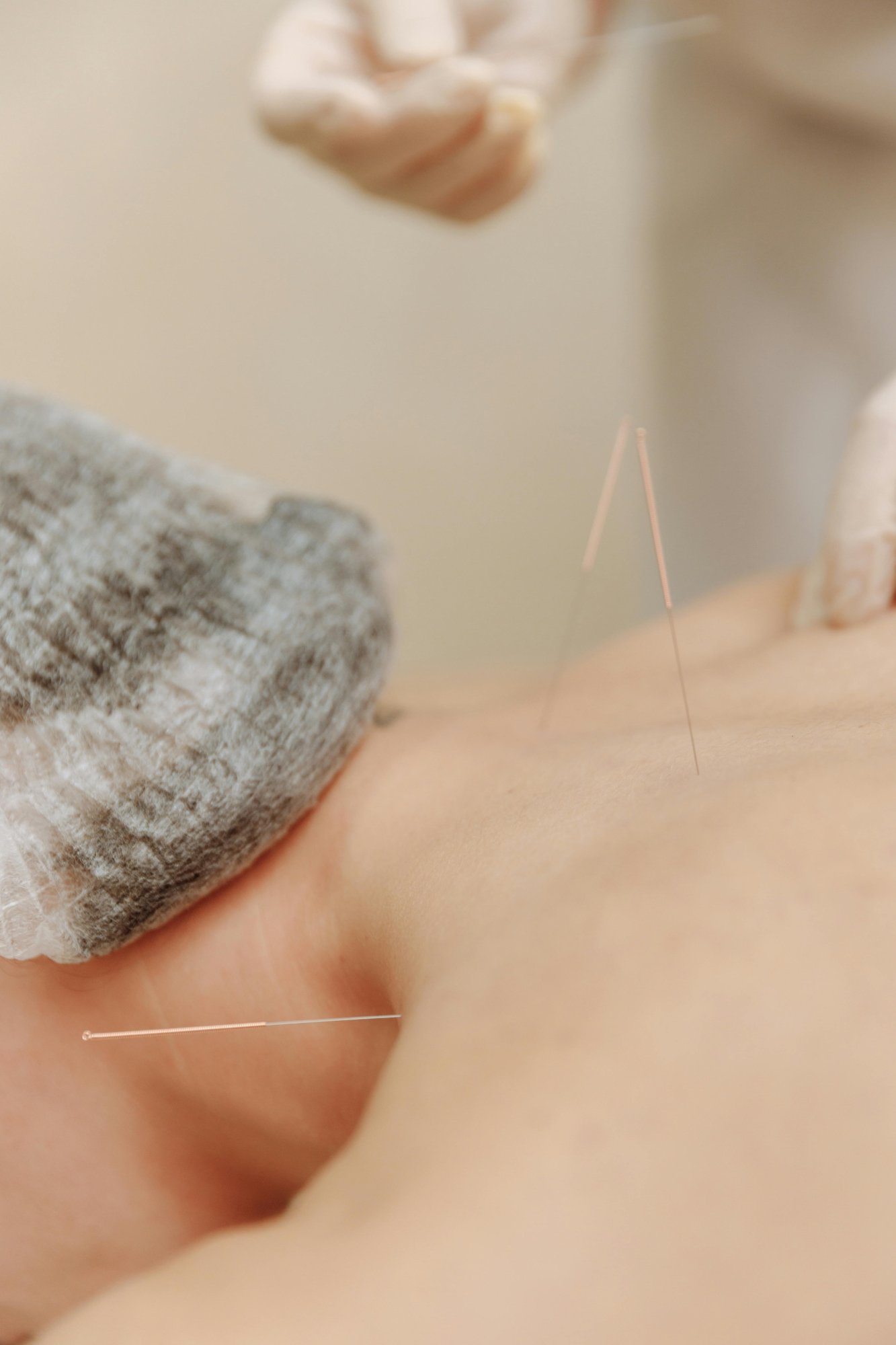 Acupuncture Treatment